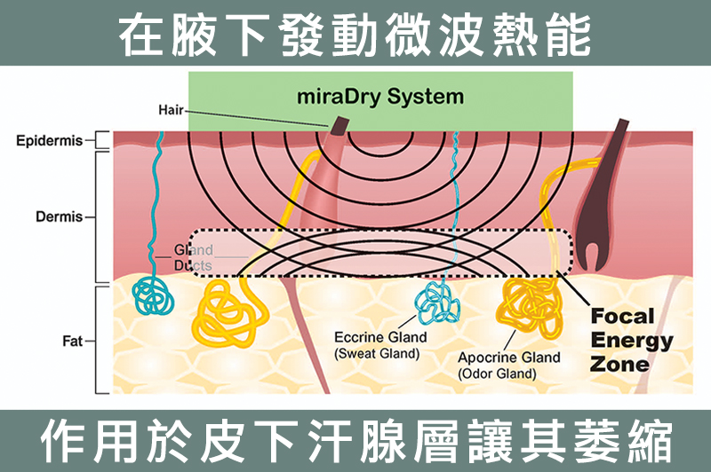 除臭、汗腺、腋下多汗、腋淨爽、狐臭、汗臭、無疤痕、美國FDA認證、除汗改善、效果持續、長效、腋下微波、熱能汗臭