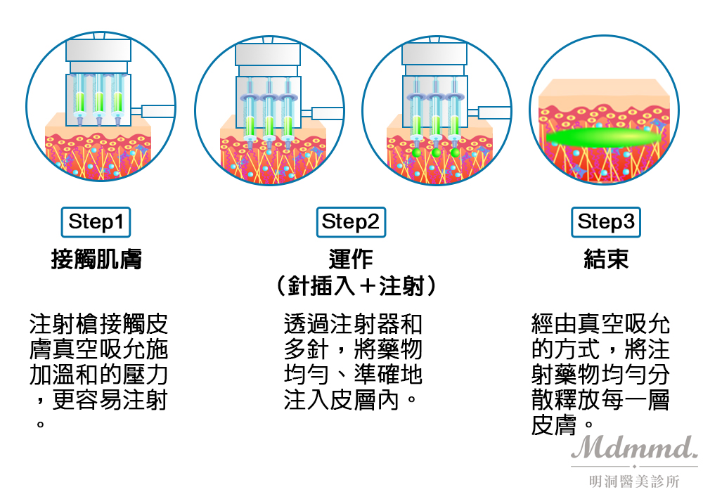  瘦身、瘦小臉、咀嚼肌、國字臉、蘿蔔腿、除皺、水光注射、眉間紋、抬頭紋、全臉拉提、肌肉放鬆、肉毒桿菌、小臉、醫美、巴掌臉、BOTOX、天使肉毒、緊緻、滋潤、彈性、光澤